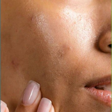 Dull Skin